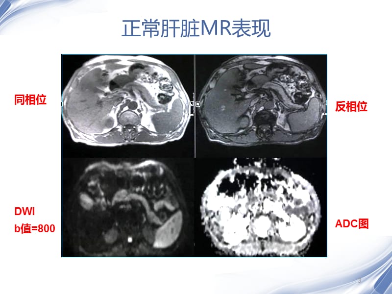 肝脏的MR表现ppt课件_第3页