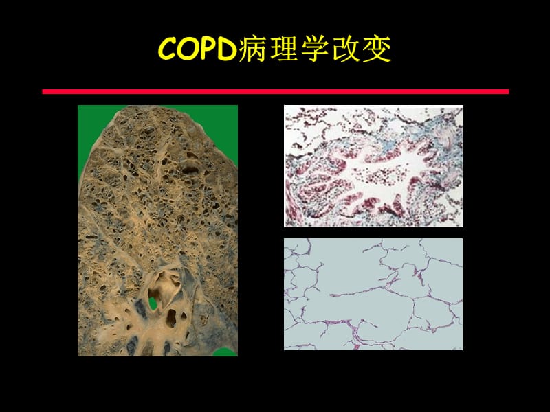 COPD机械通气治疗ppt课件_第3页