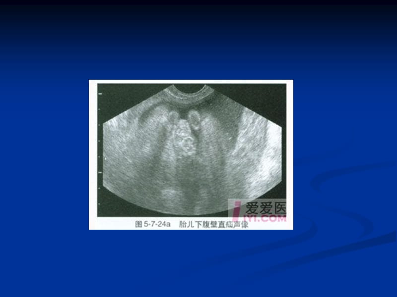 胎儿骨骼系统发育异常的超声诊断.ppt_第3页
