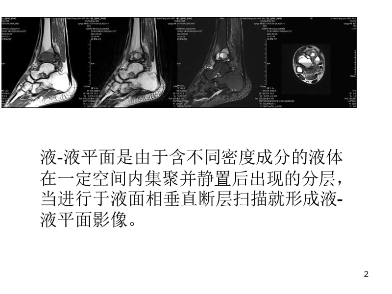 骨与软组织病变液液平面影像诊断价值ppt课件_第2页