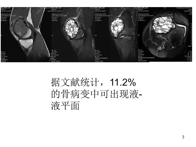 骨与软组织病变液液平面影像诊断价值ppt课件_第3页