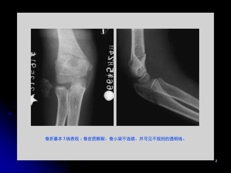 骨与软组织疾病诊断ppt课件_第2页