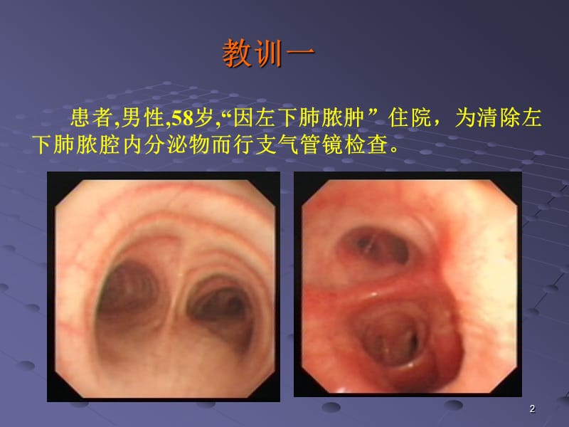 支气管镜诊疗相关大咯血的预防与救治ppt课件_第2页