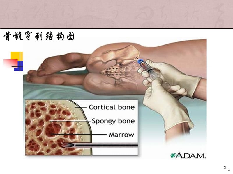 骨髓活检的病理诊断ppt课件_第3页