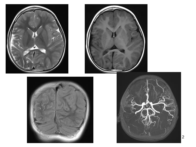 Sturge-weber综合征ppt课件_第2页