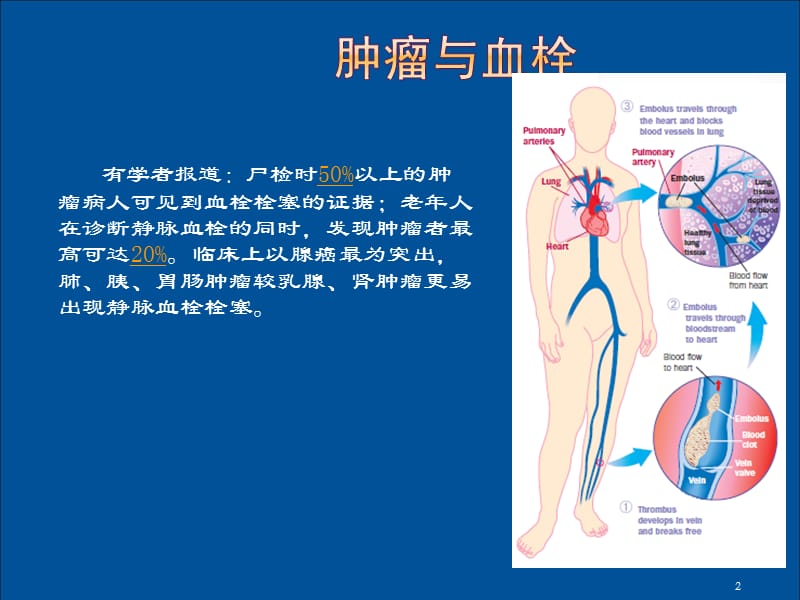 肿瘤与血栓ppt课件_第2页