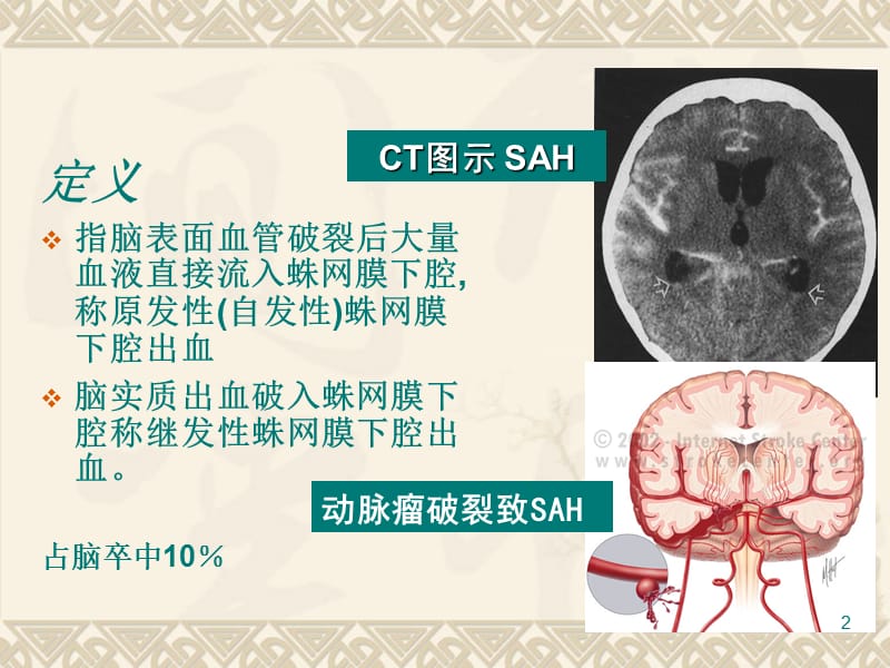 蛛网膜下腔出血ppt课件_第2页