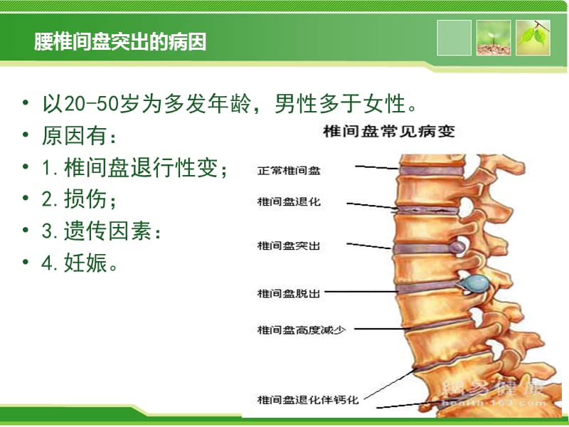 腰椎间盘突出的健康教育.ppt_第2页