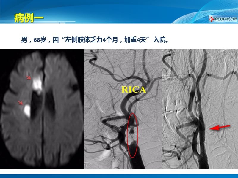 脑高灌注综合征-林航.ppt_第3页