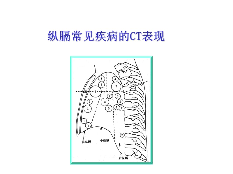 纵膈常见疾病的CT表现.ppt_第1页