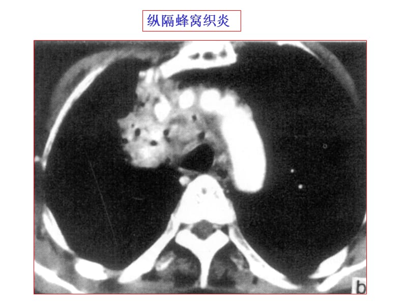 纵膈常见疾病的CT表现.ppt_第3页