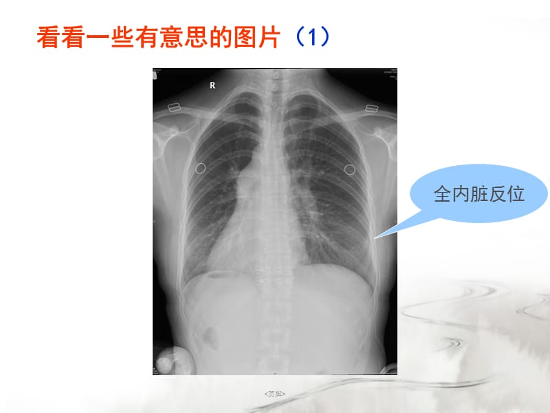 腮腺常见疾病的CT诊断-王传彬.ppt_第2页