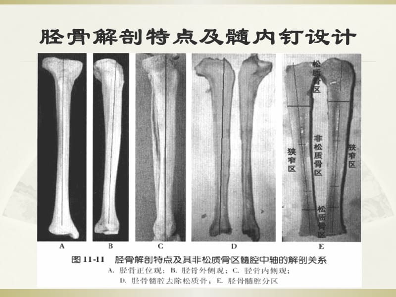 胫骨髓内钉内固定.ppt_第2页