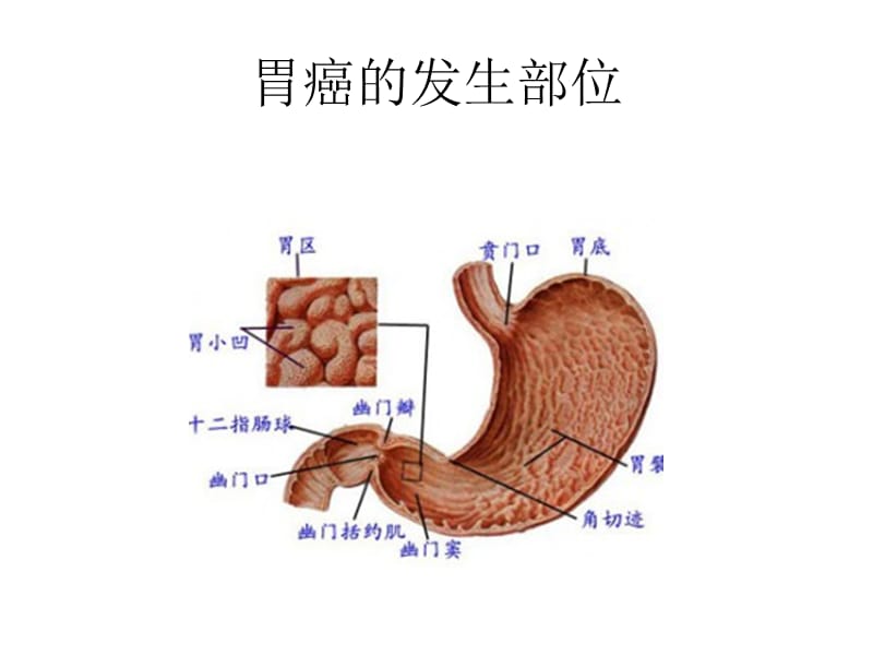 胃癌常见手术方式.ppt_第3页