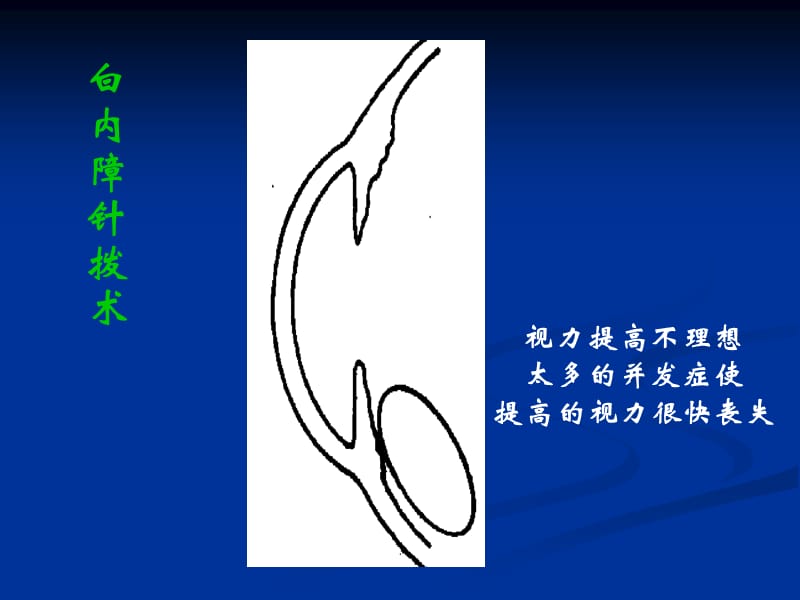 白内障ECCE(小切口囊外摘除).ppt_第3页