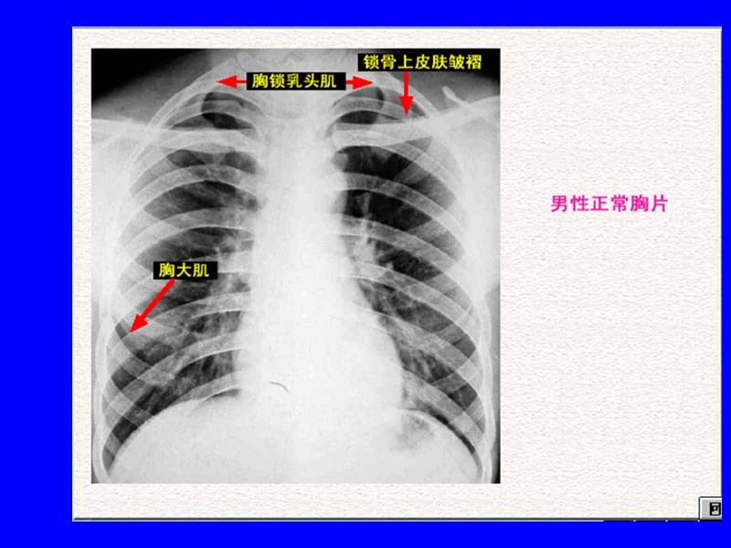 肺部正常和X线异常表现.ppt_第3页