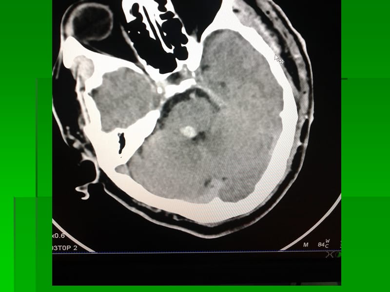 脑干海绵状血管瘤MRI.ppt_第2页