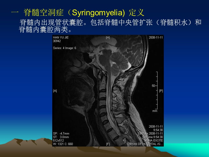 脊髓空洞症临床及影像学表现.ppt_第2页