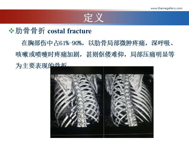 肋骨骨折的影像学表现.ppt_第2页