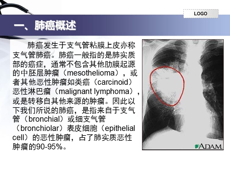 肺癌的护理-小讲课.ppt_第2页