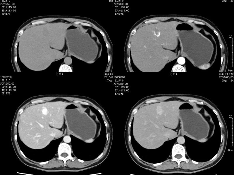 胆管细胞癌与肝脓肿影像鉴别.ppt_第2页