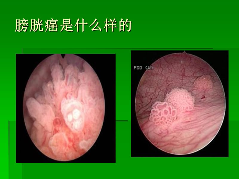 非肌层浸润性膀胱癌的诊断治疗.ppt_第2页