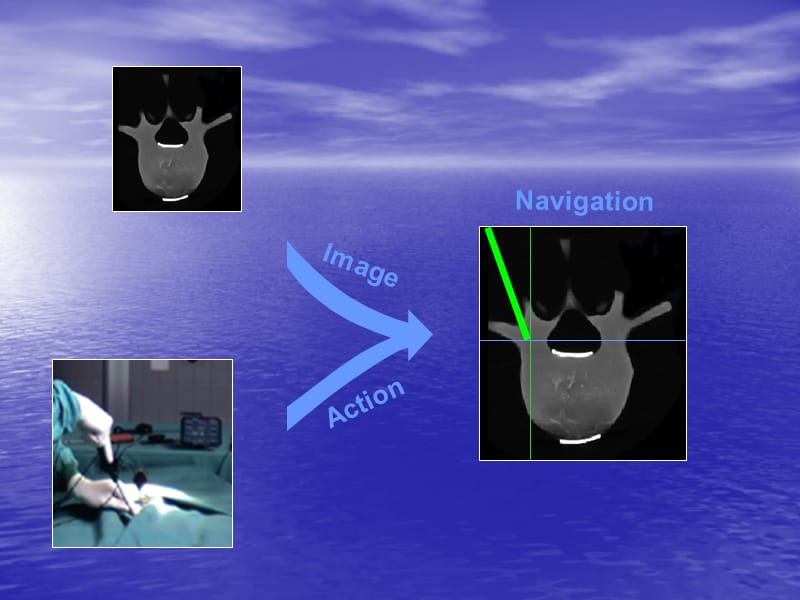 计算机导航在骨科手术中的应用.ppt_第3页