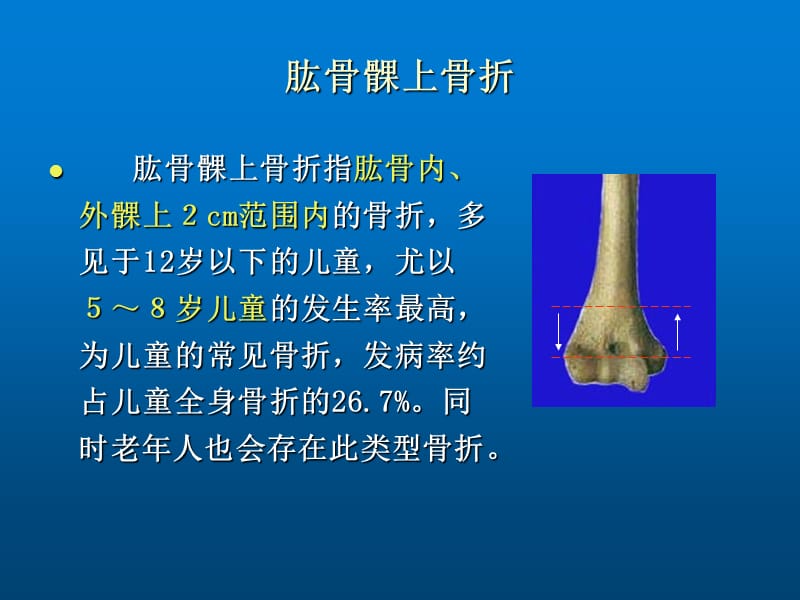 认识肱骨髁上骨折.ppt_第2页