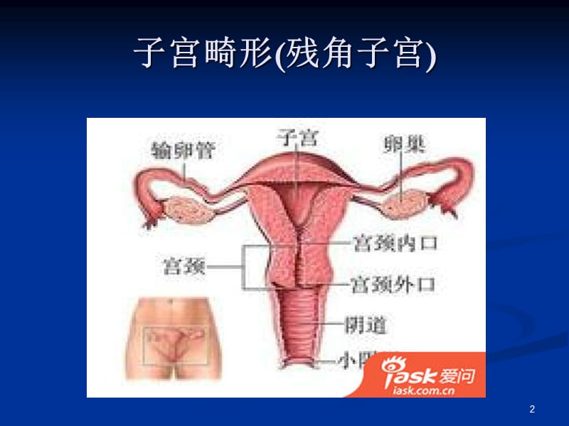 残角子宫ppt课件_第2页