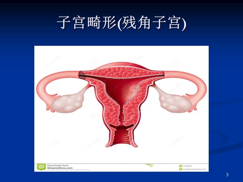 残角子宫ppt课件_第3页