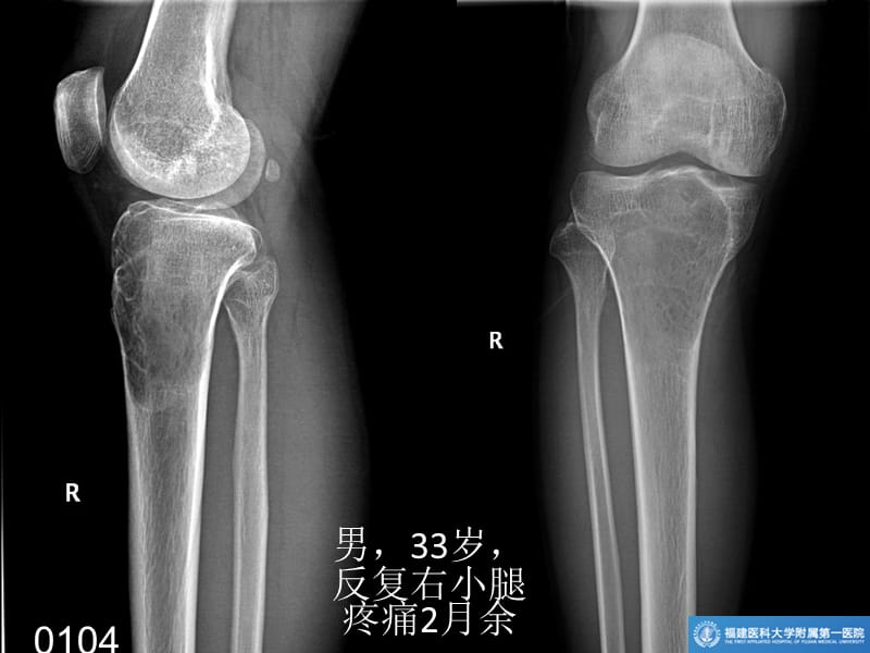 长骨良性纤维组织细胞瘤_第1页