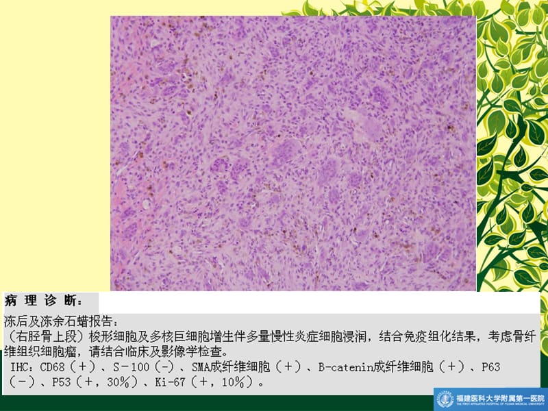 长骨良性纤维组织细胞瘤_第2页