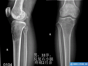 长骨良性纤维组织细胞瘤