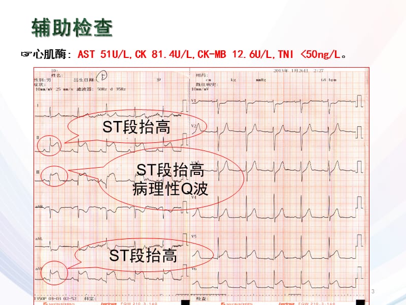 PBL急性心梗ppt课件_第3页