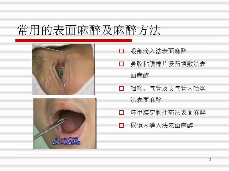 常用局部麻醉方法ppt课件_第3页