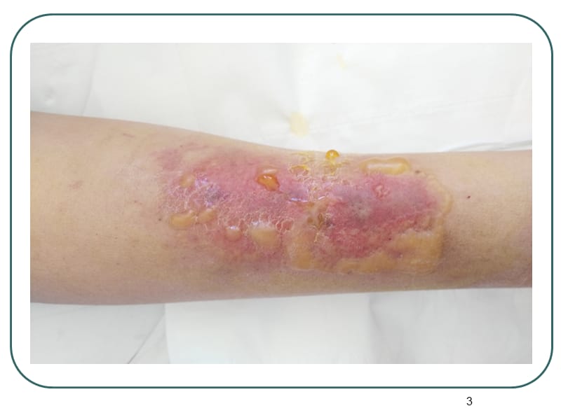 刺激性药物外渗后的处理ppt课件_第3页
