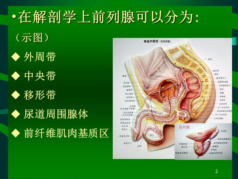 PVP手术护理配合ppt课件_第2页