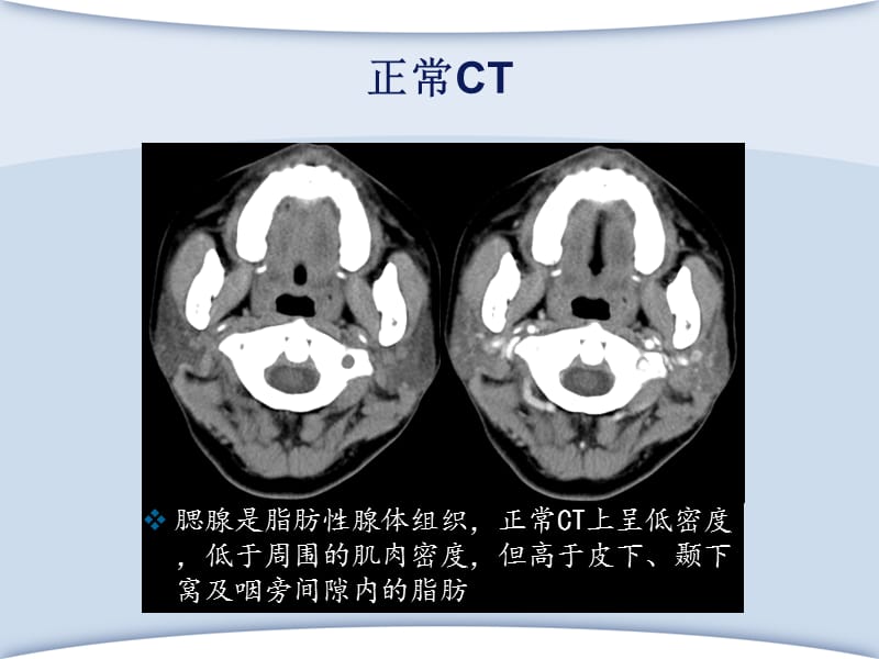 腮腺肿瘤ppt课件_第3页