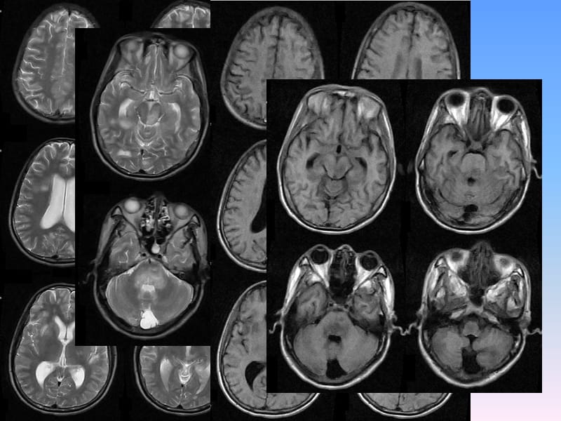 CNS疾病MRI诊断_第3页