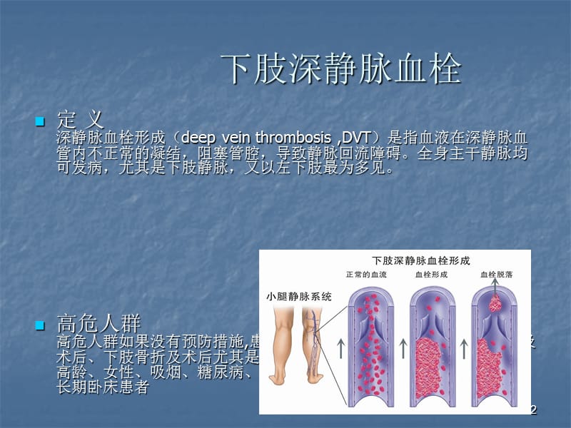 VTE下肢静脉血栓ppt课件_第2页