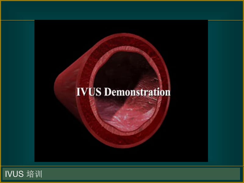 IVUS 血管内超声基础和临床ppt课件_第2页