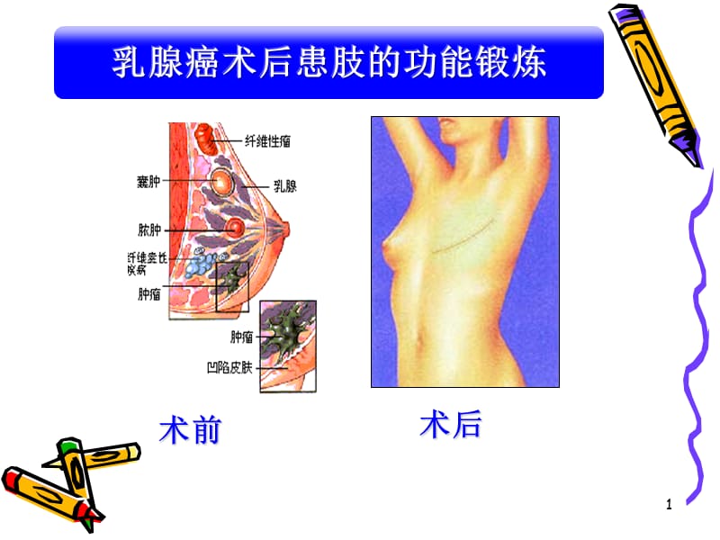 乳腺癌术后的功能锻炼ppt课件_第1页