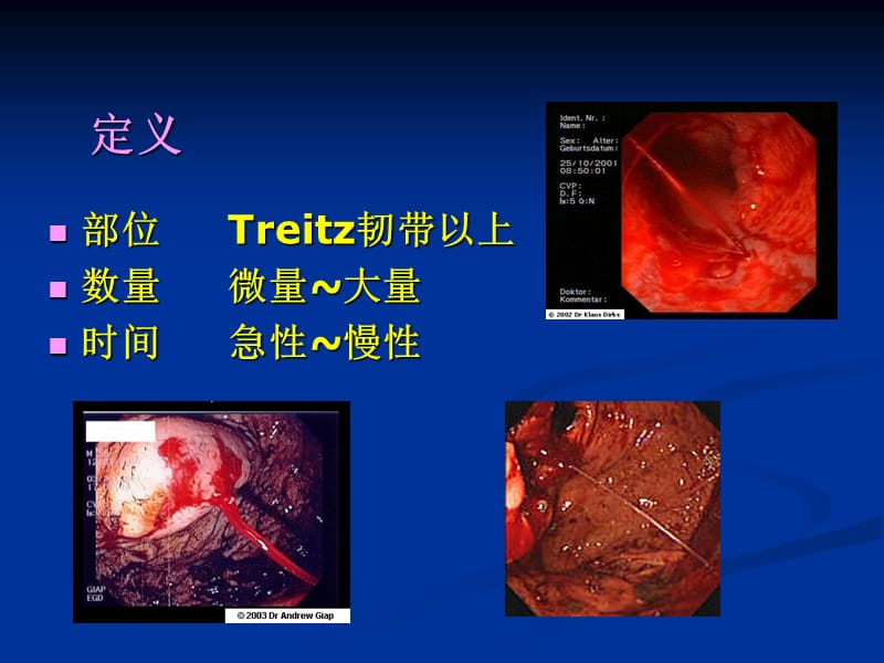 上消化道出血诊治PPT课件_第3页