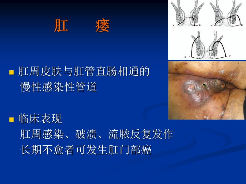 AEM治疗肛瘘一种微创治疗肛瘘的新方法ppt医学课件_第2页