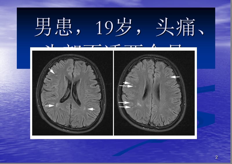 TCD发泡实验在神经内科疾病中应用的典型病例分析ppt课件_第2页