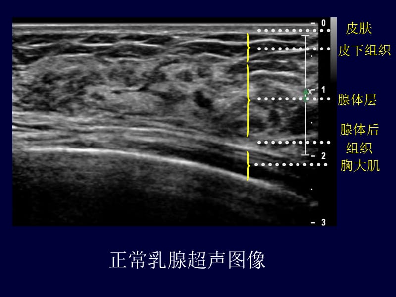 乳腺超声培训ppt课件_第3页