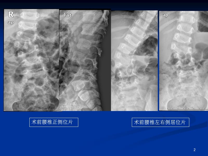 pso截骨ppt课件_第2页