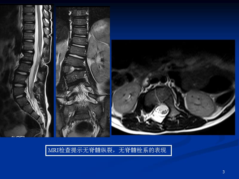 pso截骨ppt课件_第3页