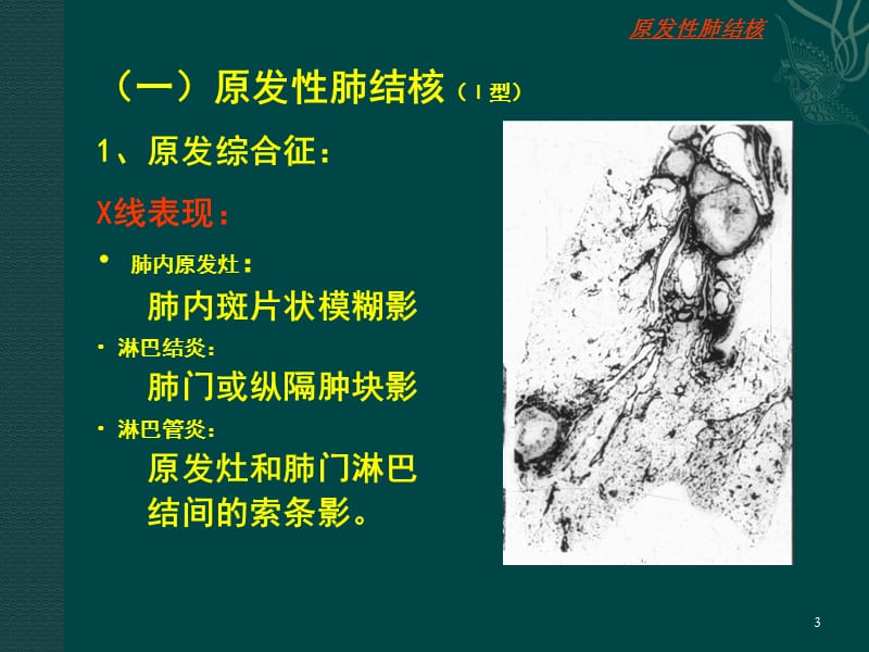 肺结核肺肿瘤ppt课件_第3页