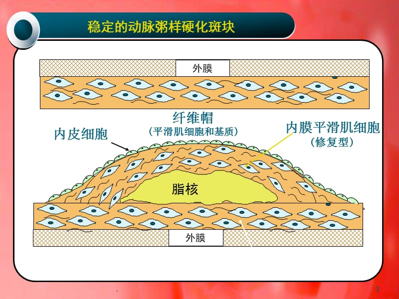 不稳定心绞痛ppt演示课件_第3页